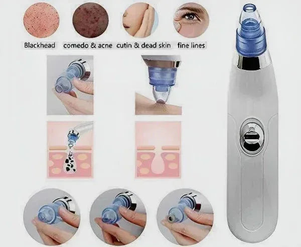 Derma Suction Blackhead Remover - 3-in-1 Vacuum Pore Cleaner for Acne & Pimples - Mix Bazar - Mix Bazar